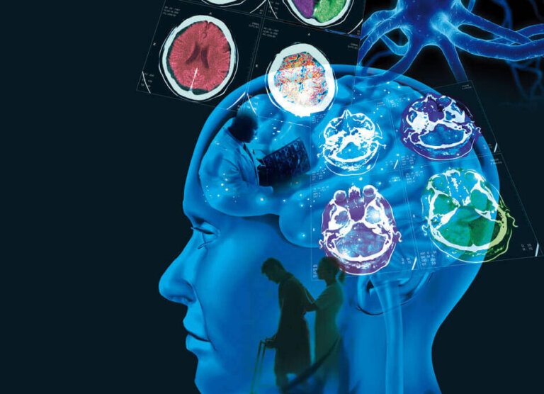 Esclerose múltipla: causas, sintomas e tratamento