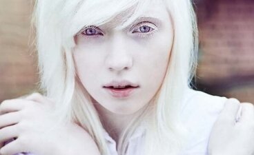 Pessoas albinas: além da aparência física