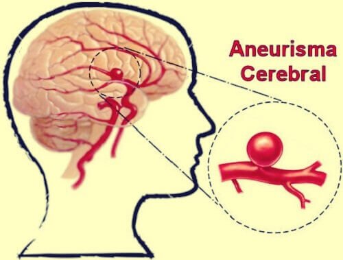 Aneurisma cerebral: definição, sintomas e tratamentos