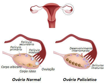 Como é viver com a síndrome dos ovários policísticos?