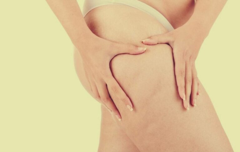 Lipedema, além da obesidade: sintomas e tratamento